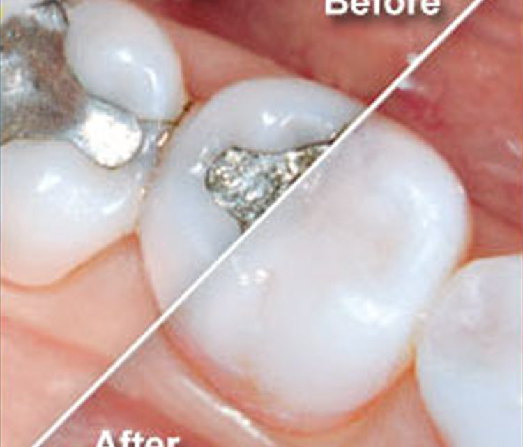 Why amalgam fillings should be replaced by resin fillings