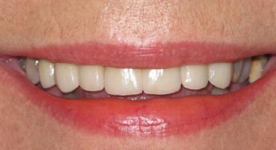 After-Whitening